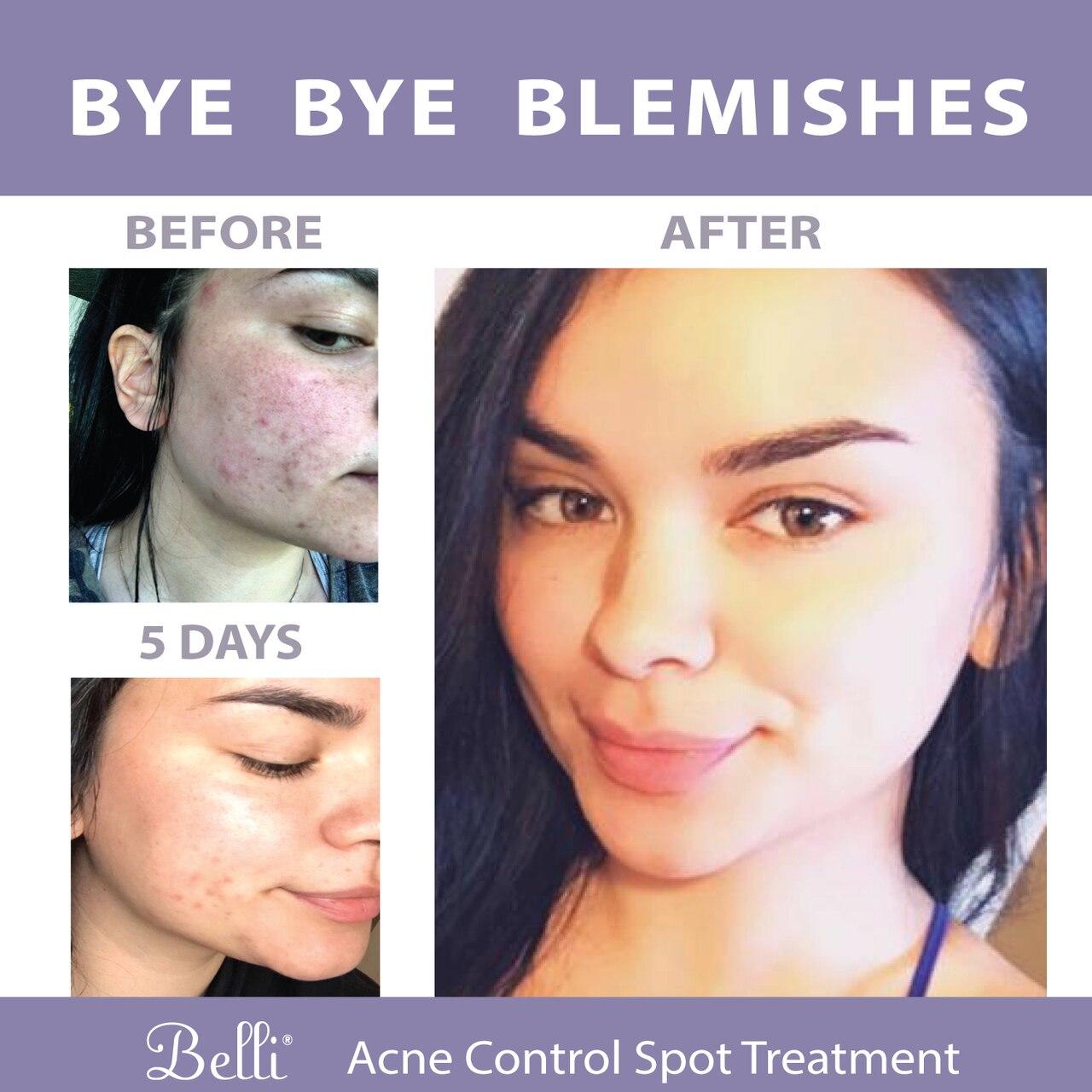 Acne Control Spot Treatment