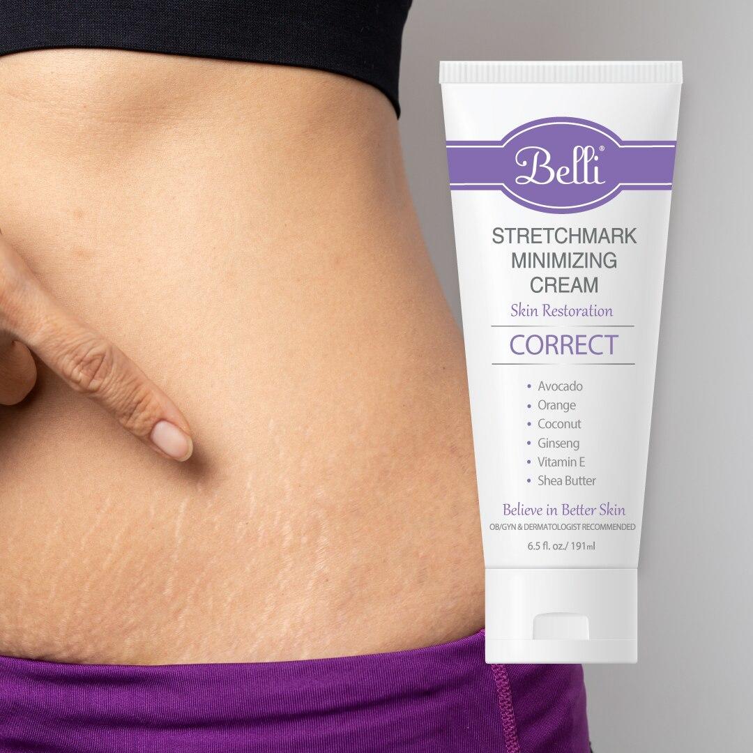 Stretch mark cream